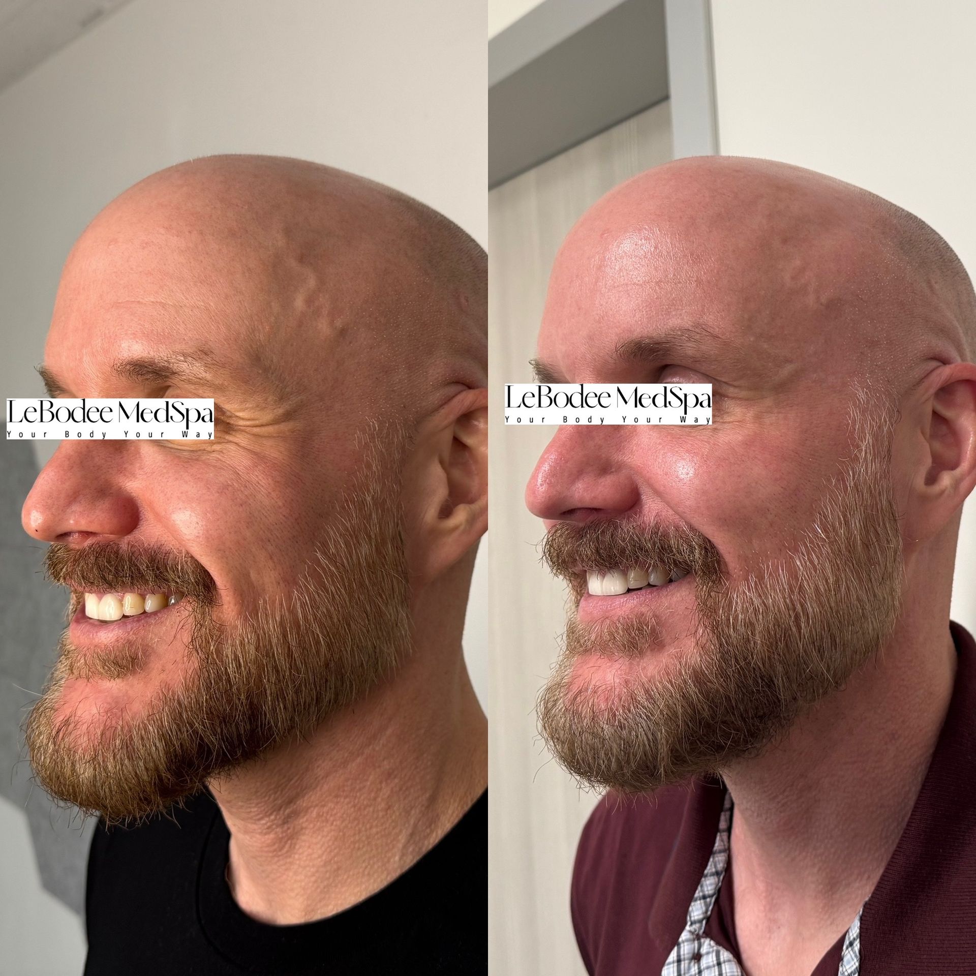 Before and after photos of a man with fewer wrinkles, smiling, in a medical spa setting.