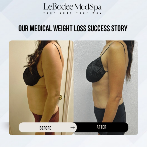 Before-and-after photos of a woman who lost weight at LeBodee MedSpa. Shows slimmer torso and side view.