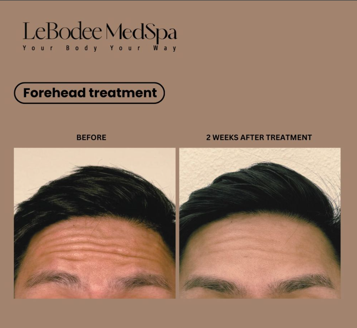 A before and after photo of a man 's forehead treatment