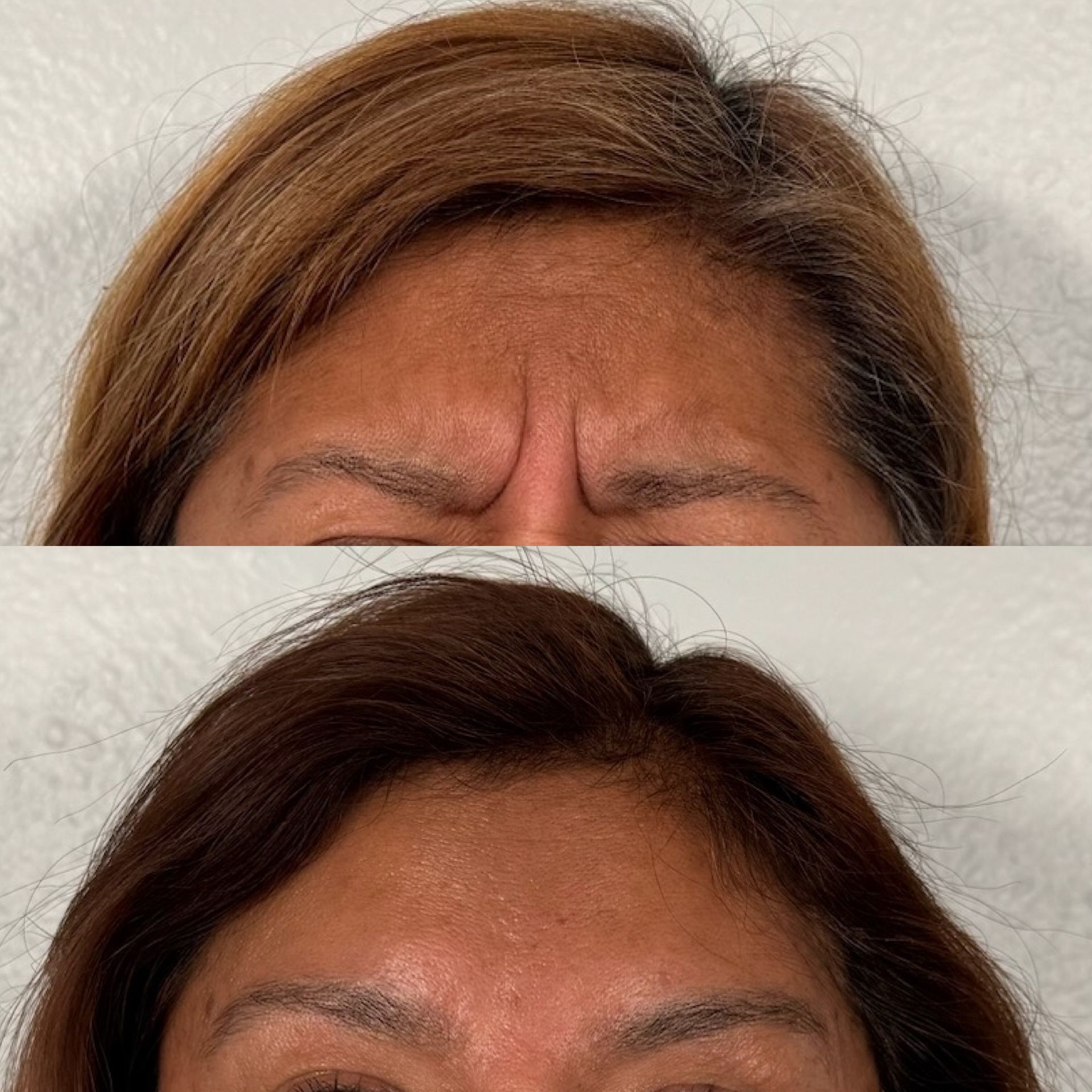 A before and after photo of a woman 's forehead