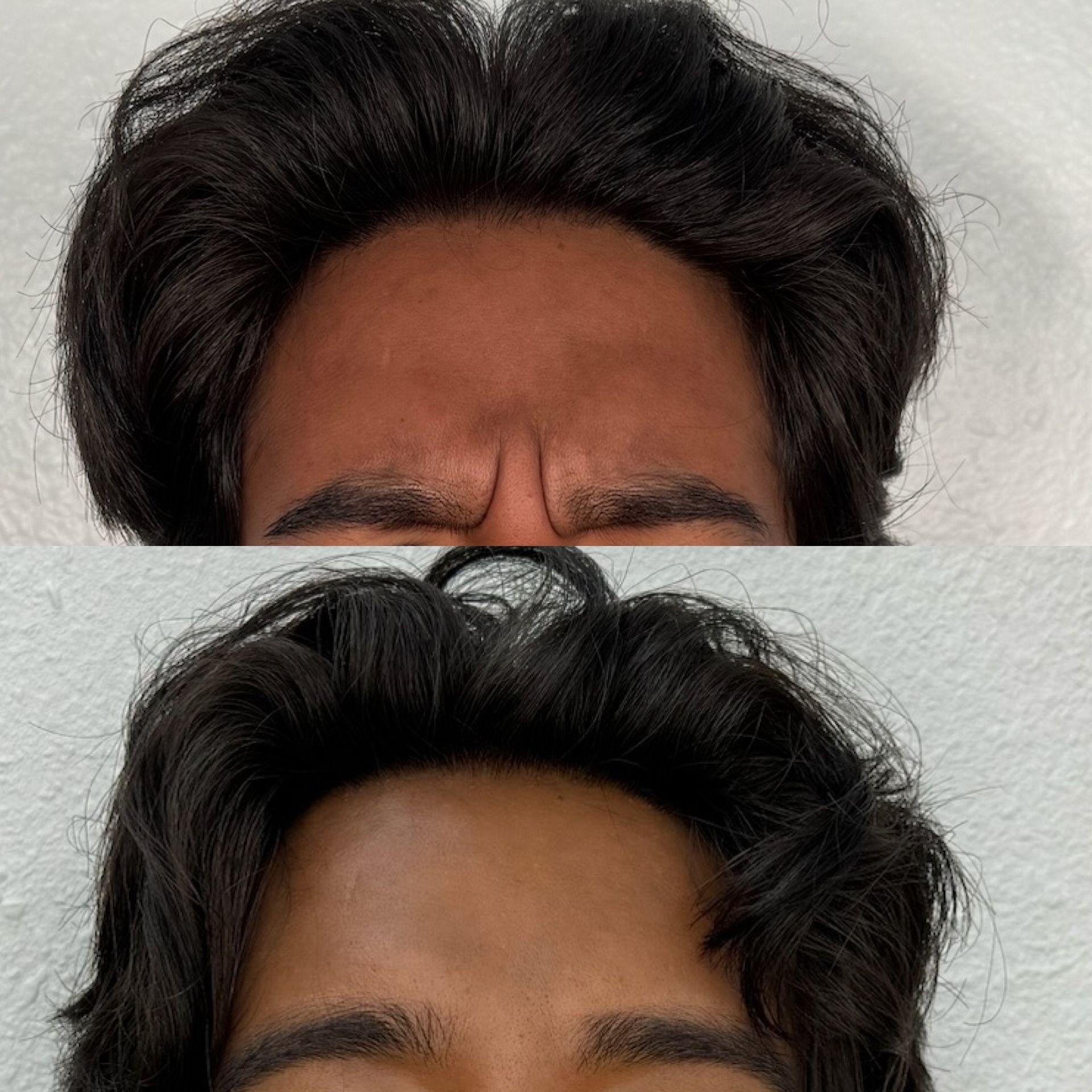 A before and after photo of a man 's forehead.