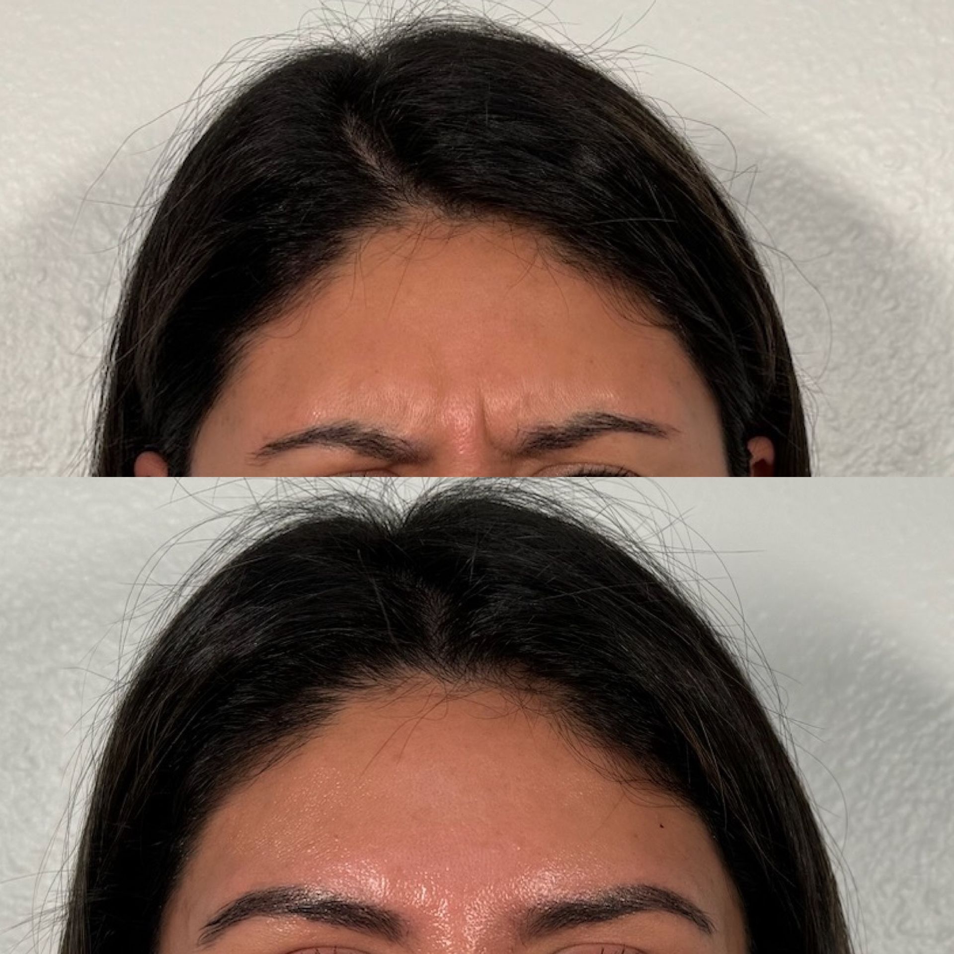A before and after photo of a woman 's forehead.