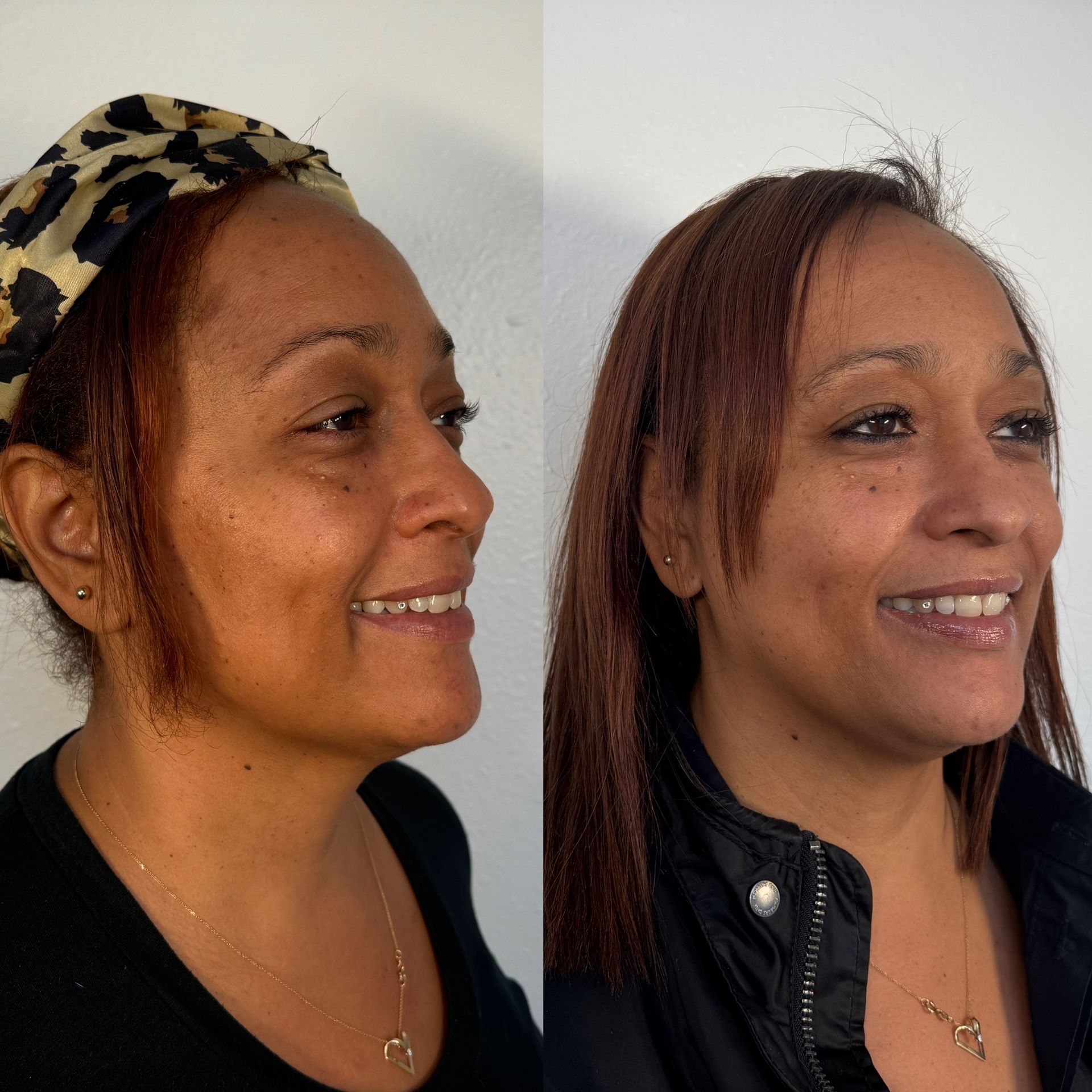 A before and after photo of a woman with botox