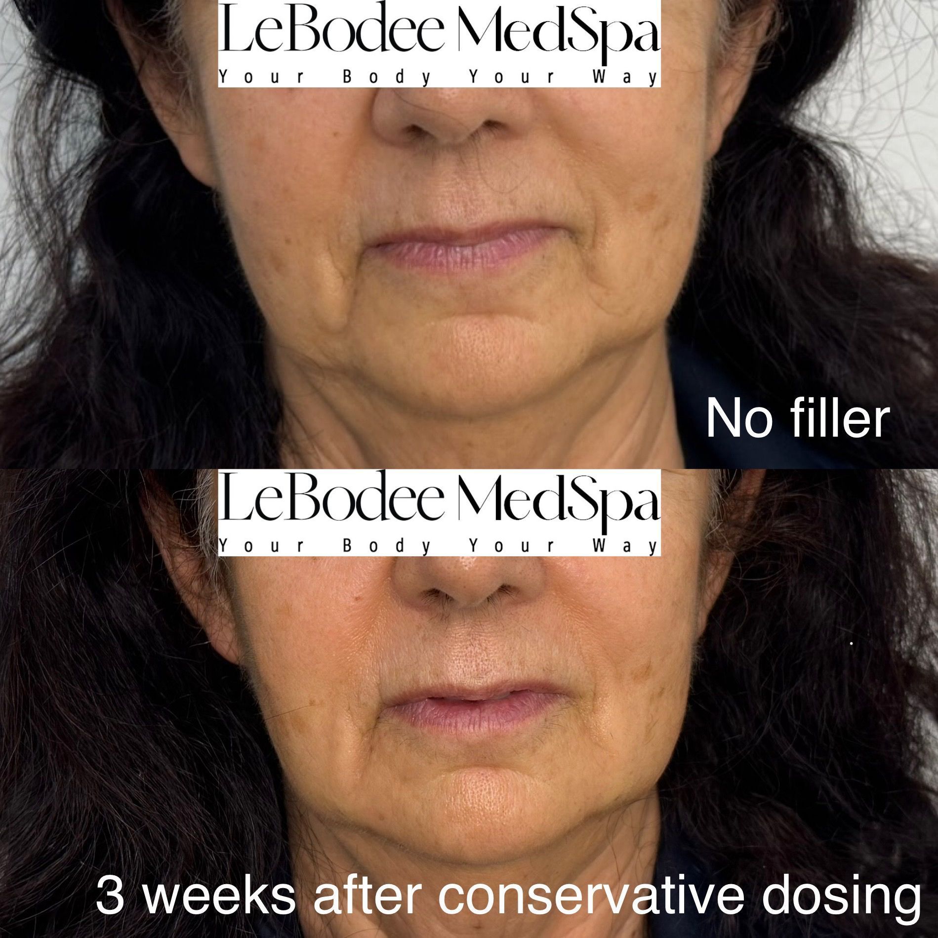 Comparison of a woman's face before and after filler injections to reduce wrinkles.