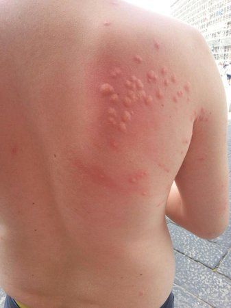 skin rash with huge welts caused by bed bugs