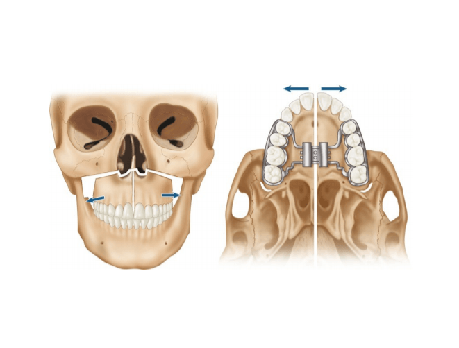 Oral Surgery — Example of a Jaw Model in San Diego, CA