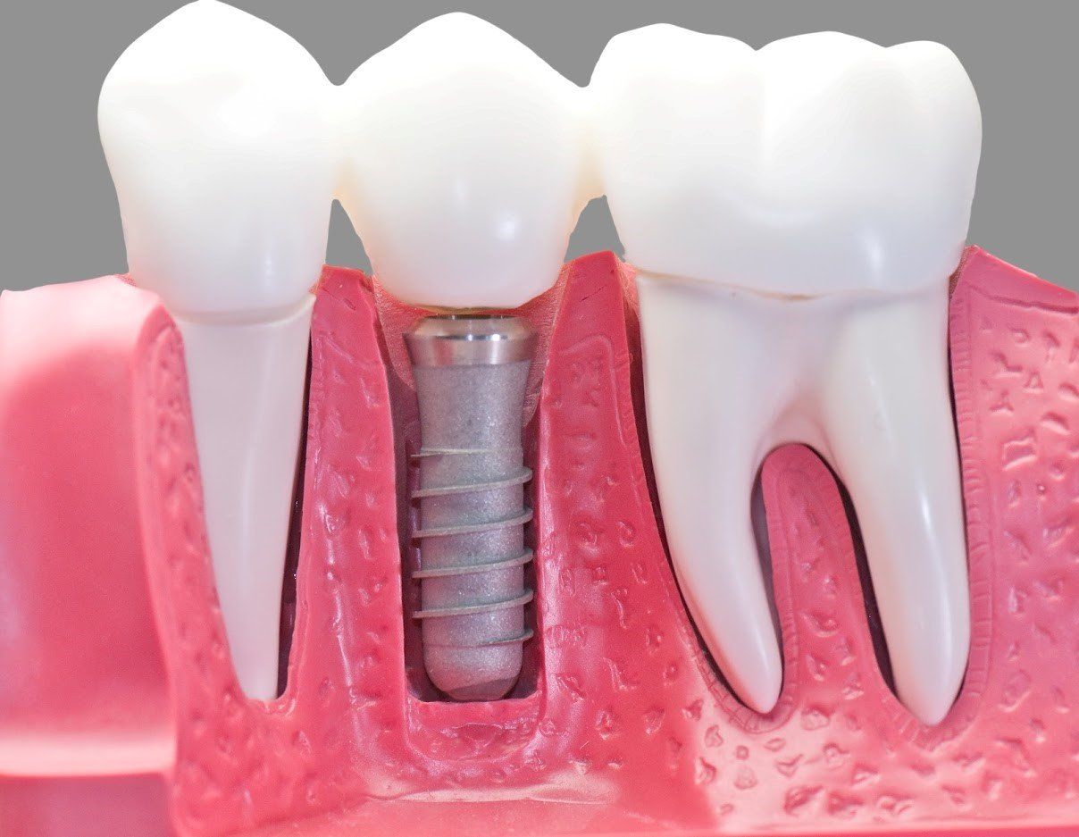 Dental Implant - San Diego, CA — San Diego Center for Oral & Maxillofacial Surgery