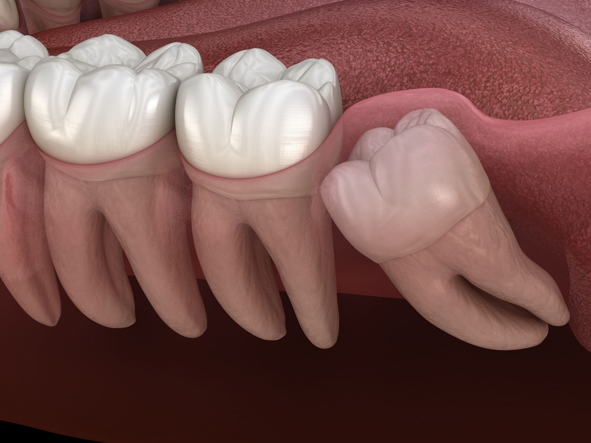 Impacted wisdom tooth, partially emerged, pressing against adjacent molar.