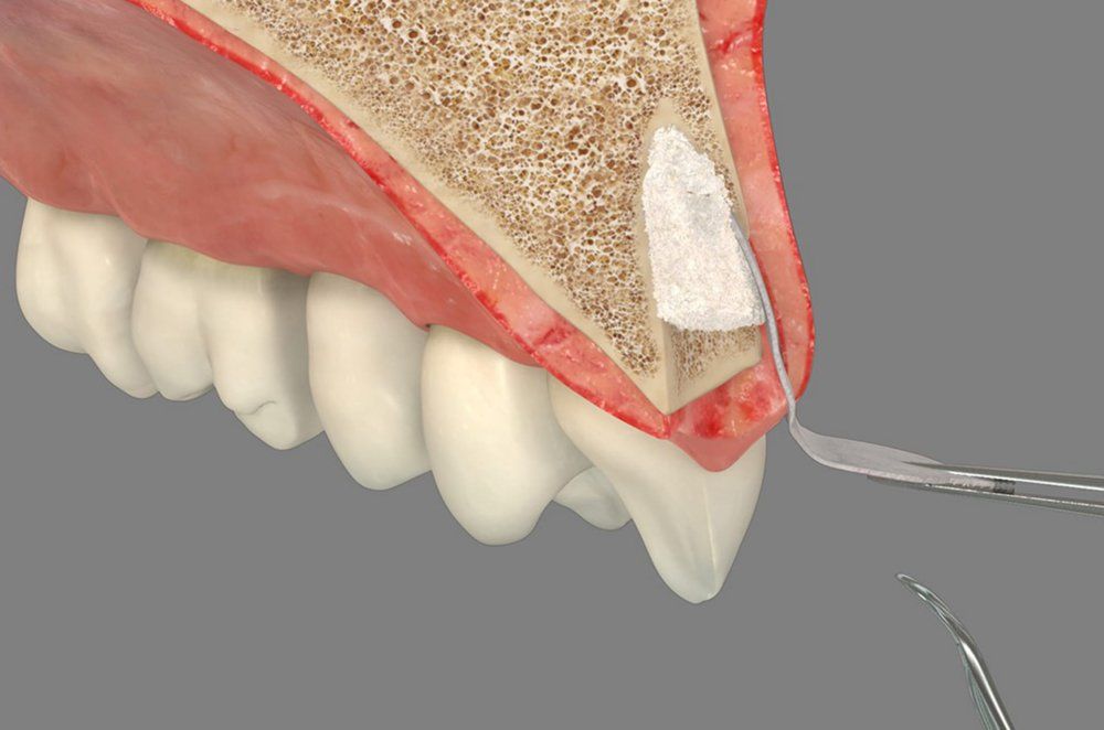 Bone Grafting — Joint of the Lower Jaw and the Ear Canal in San Diego, CA