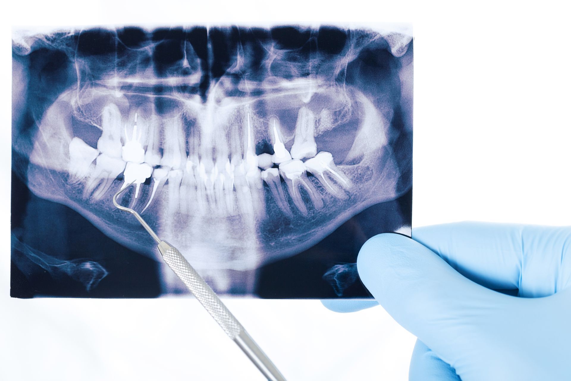 Close-up of an x-ray image of someone’s teeth and jaw, being held by a gloved hand.