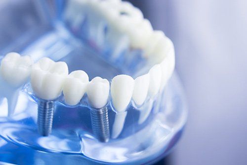 Dental Implants San Diego — Tooth Plastic Model With Screw Implant in San Diego, CA