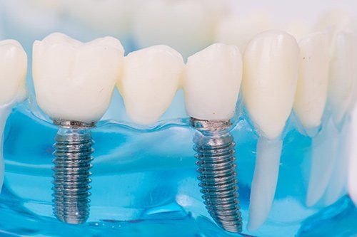 Dental Implant Procedure San Diego, CA — Close-Up Look of Tooth Implant in San Diego, CA
