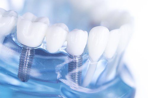 Oral Surgery — Tooth Replacement in San Diego, CA