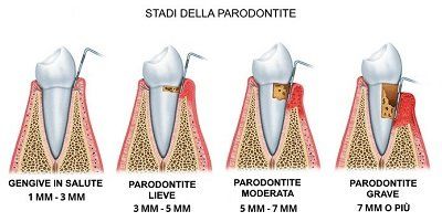 immagine da manuale che mostra gli stadi di progressione della parodontite