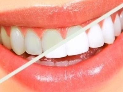 il colore dei denti prima e dopo un trattamento di sbiancamento dentale