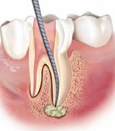 intervento di devitalizzazione della radice del dente