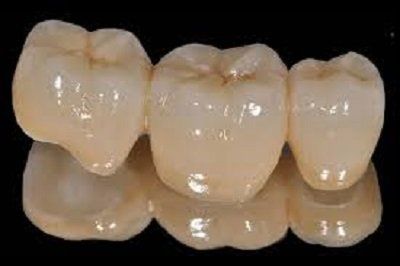 elementi dentari protesi