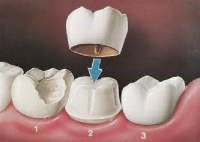 corona dentale