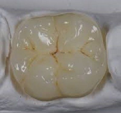 corona dentale dente fratturato