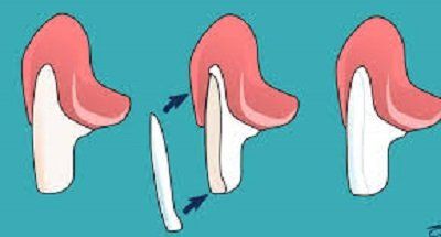 protesi fisse superficie esterna dente