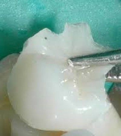 ricostruzione del dente