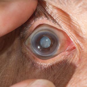 Close-up of a human eye with a cloudy, opaque lens, possibly indicating a cataract.