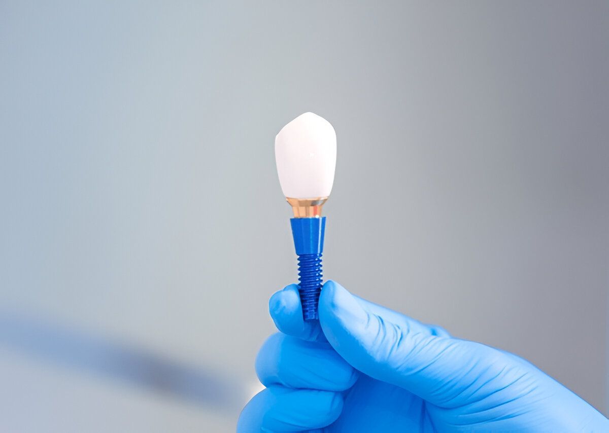 Dental Implants