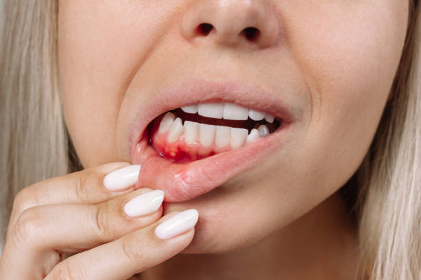 Inflamed gums