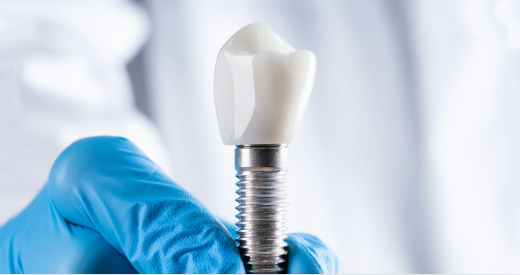 Are you a good candidate for dental implants?