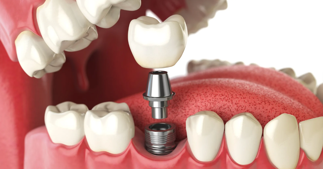 Mini vs. Traditional Implants: Differences Explained