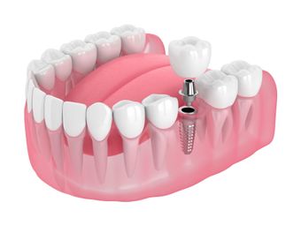 dental implants