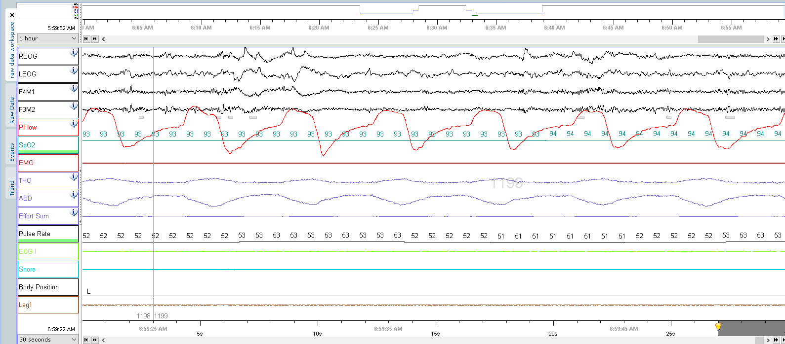 A medical graph displaying multiple wave patterns, likely monitoring vital signs with colored lines and numbers.