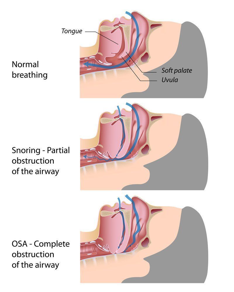 A Diagram of a Person's Breathing Process — Mid North Coast Sleep Clinic in Taree, NSW