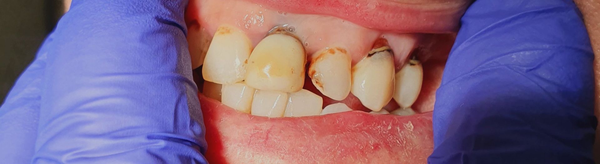 A close up of a person's teeth with blue gloves on.