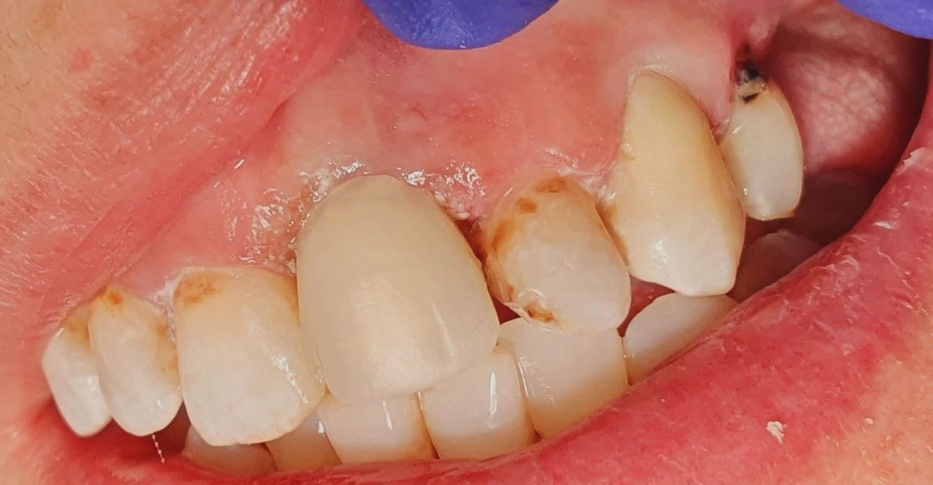 A close up of a person's teeth with a purple glove on.