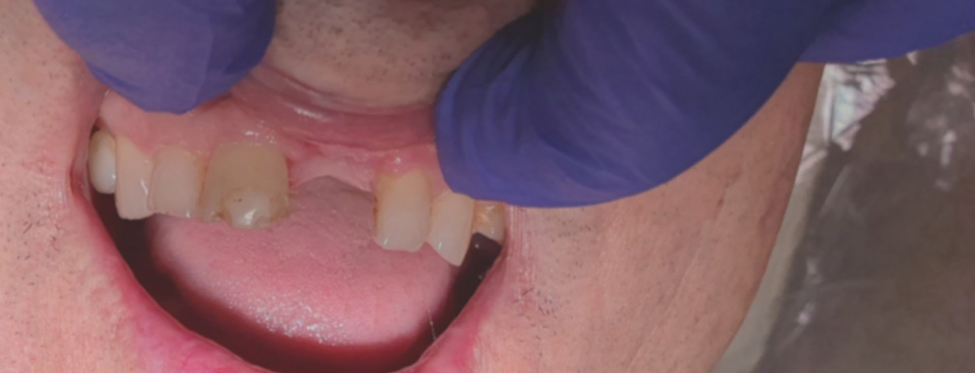 A close up of a man's mouth missing tooth