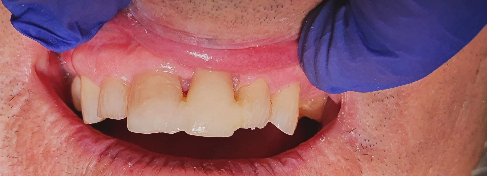 A close up of a man's mouth with blue gloves on.