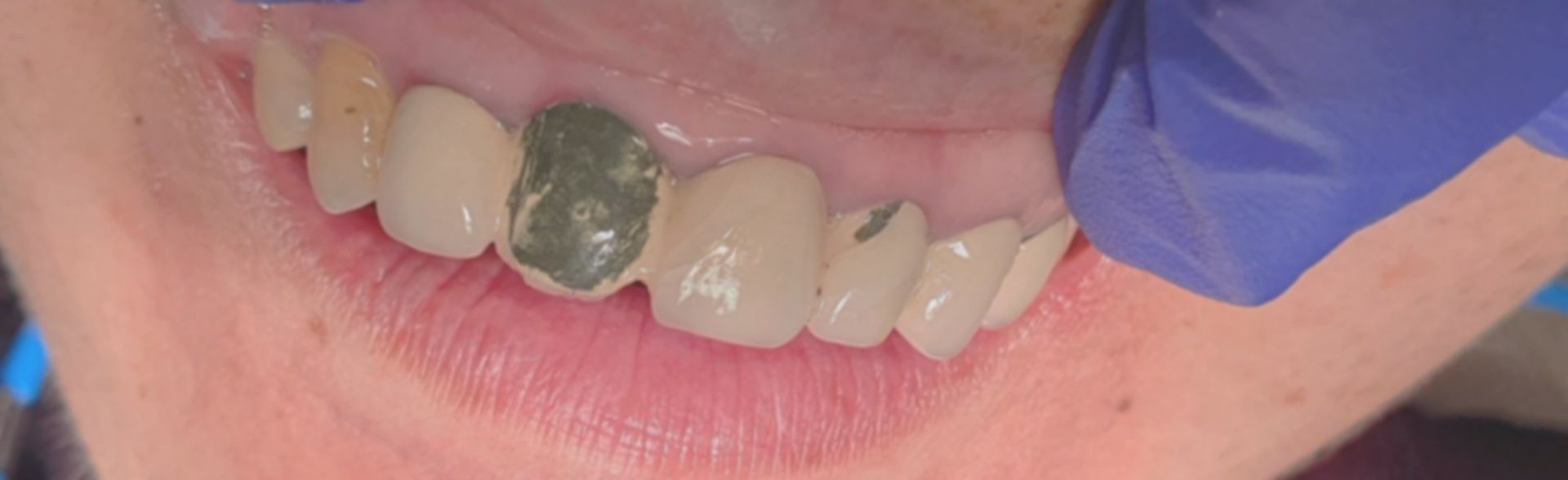 A close up of a person's teeth with a blue glove on.