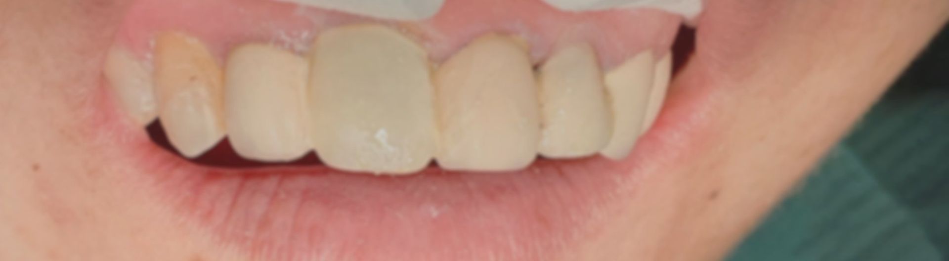 A close up of a person's mouth with white teeth.