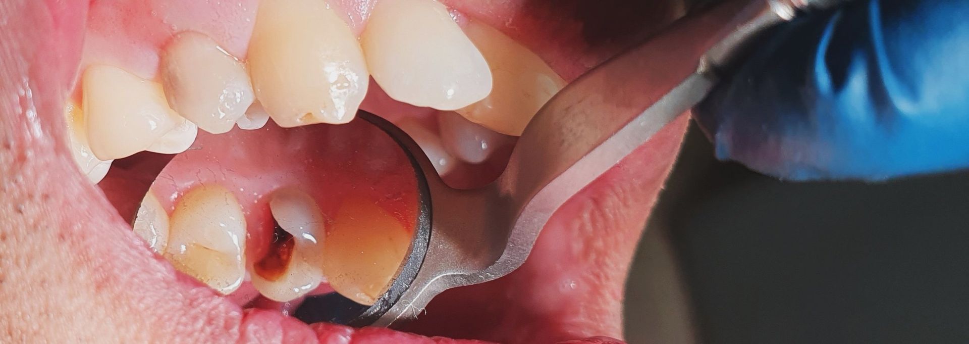 A dentist is examining a patient's teeth with a mirror.
