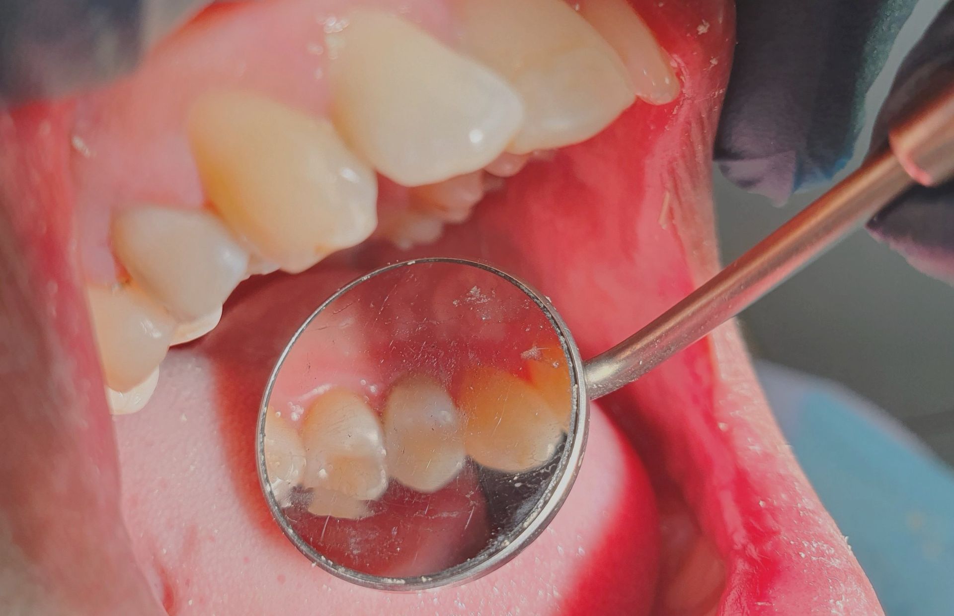 A dentist is checking a patient's teeth with a mirror.