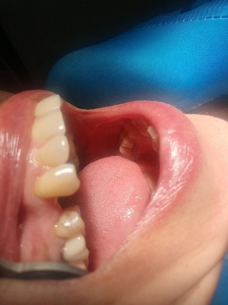 A dentist is examining a patient's teeth with a mirror.