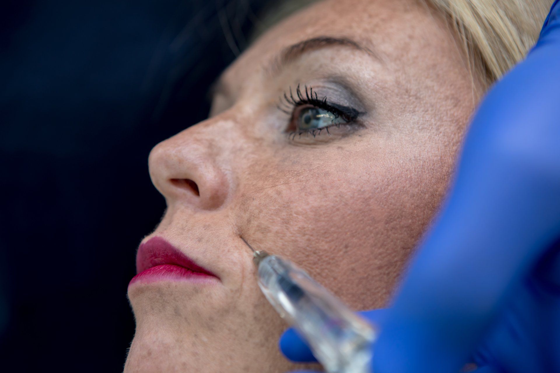 trattamento di chirurgia estetica a Venezia con filler