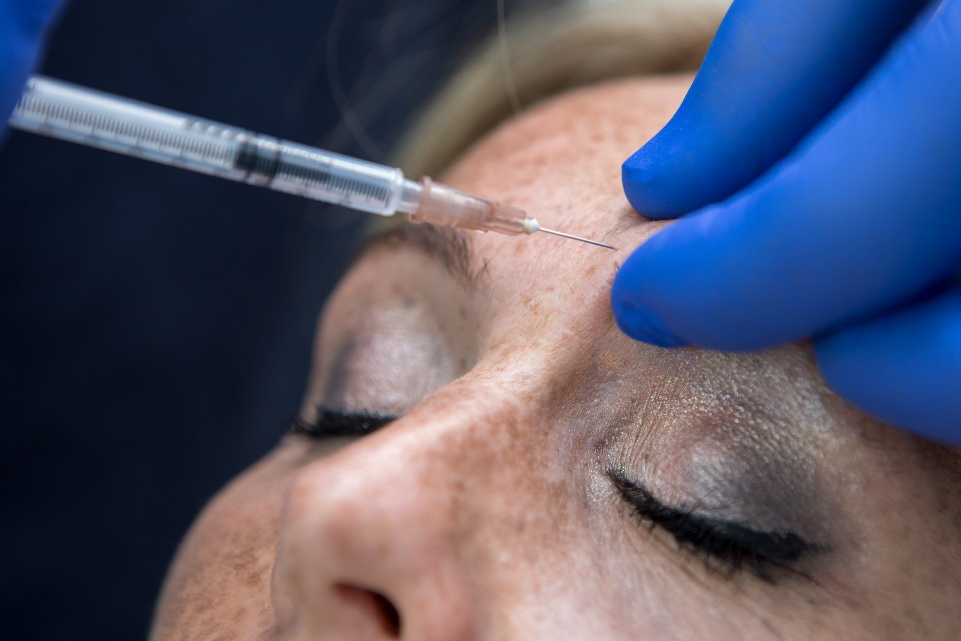 chirurgia estetica a Venezia con filler