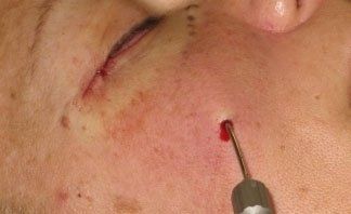 Intervento con filler antinvecchiamento