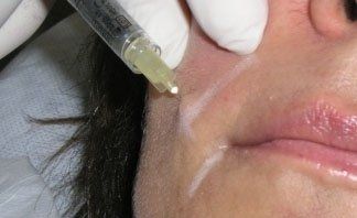 Inserzione di filler nel viso