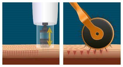 Illustrazione del microneedling