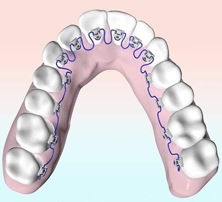 Lingual braces — Buffalo Grove, IL — Rosen Orthodontics