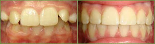 Crowding teeth before and after — Buffalo Grove, IL — Rosen Orthodontics