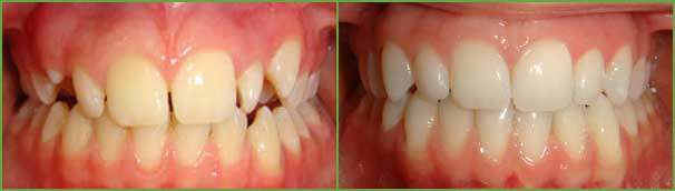 Impacted cuspids before and after — Buffalo Grove, IL — Rosen Orthodontics